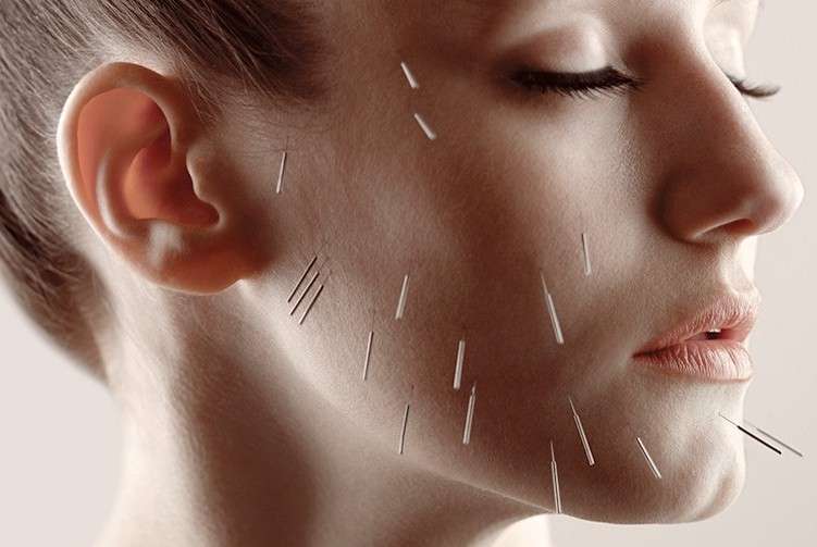 Facial Acupuncture: Unlocking the Power of Natural Rejuvenation