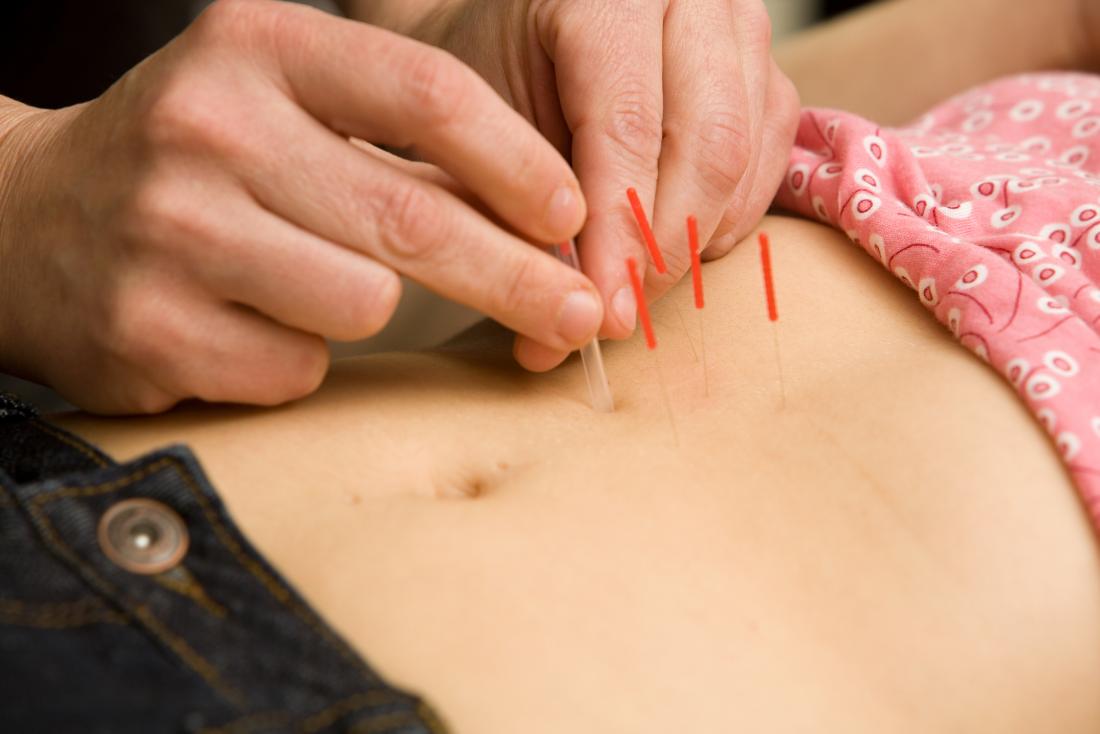 Acupuncture An Old Path to Health